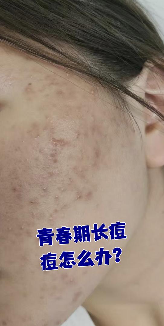 一般青春期长痘痘会持续时间